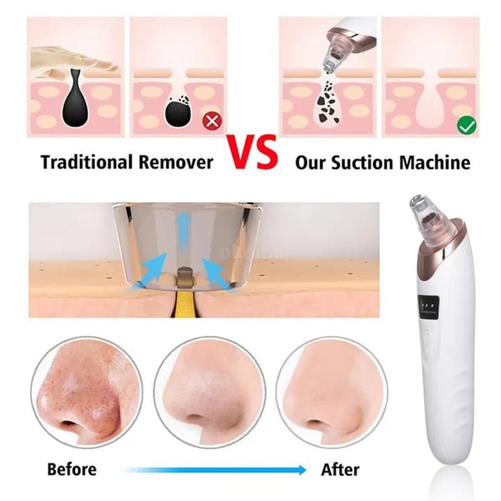 Face Blackheads Remover Tool – Pore Cleaner for Nose, Chin & Forehead
